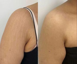 Before and After Photos of stretch mark camouflage treatment on shoulder and arms