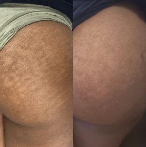 Before and After Photos of stretch mark camouflage treatment on butt