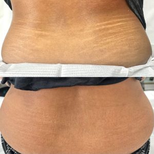 Before and After Photos of stretch mark camouflage treatment on lower back