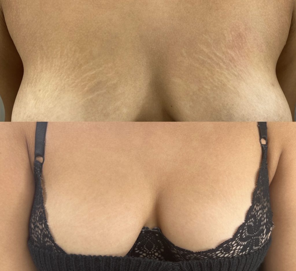 Before and After Photos of stretch mark camouflage treatment on breast