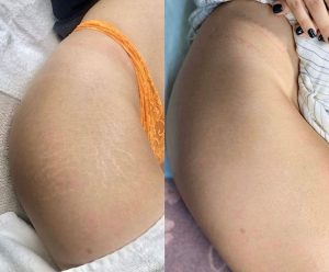 Before and After Photos of stretch mark camouflage treatment on thighs and hip
