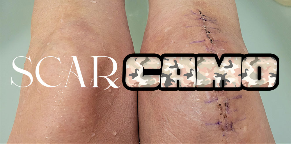 Paramedical tattoo for scar and stretch marks