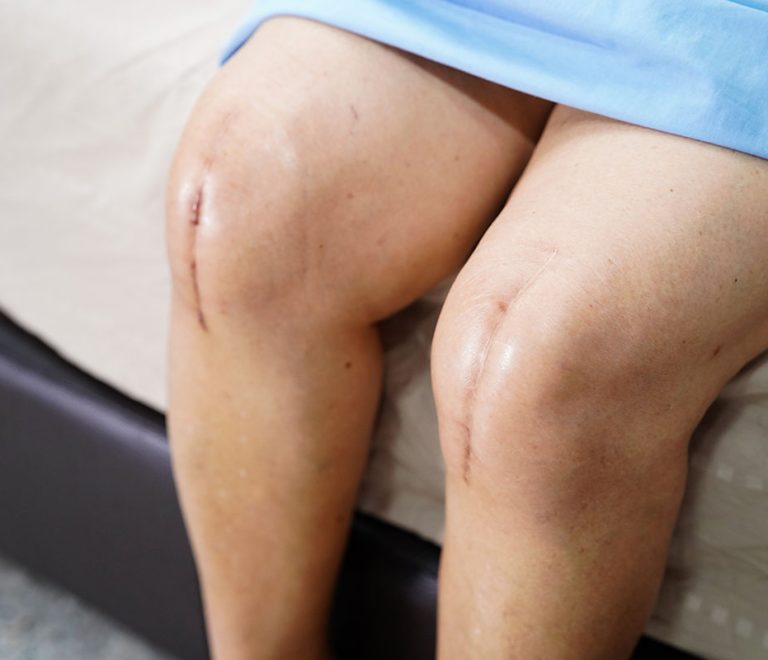 Knee Replacement Scar Tattoo: The Camouflage Transformation