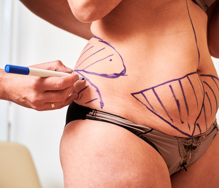 Effective Liposuction Scar Treatment Options: What You Need to Know