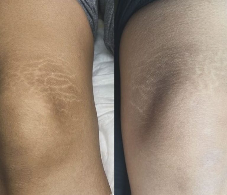 Effective Knee Stretch Marks Treatments: Options And Prevention